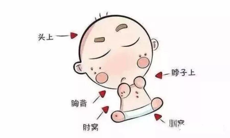 去除婴儿热疹小妙招_湿疹是一热就红一凉就不红